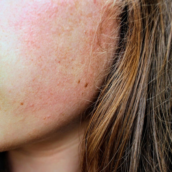 Sensitive Skin: Self-Help Tips And Treatment Options